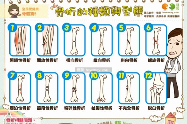 骨折的认识-骨折的原因与分类 – Bone Fracture – Types and Causes of Bone Fractures
