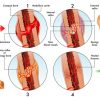 骨折的认识-骨折的痊愈-Bone Fracture Healing Process