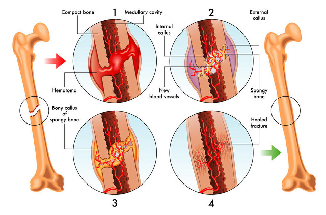 骨折的认识-骨折的痊愈-Bone Fracture Healing Process